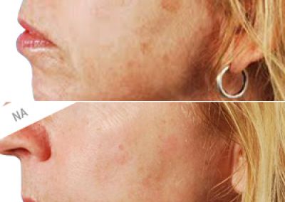 Cryotherapie Cryotherapie
