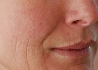 Anti-aging Anti-aging