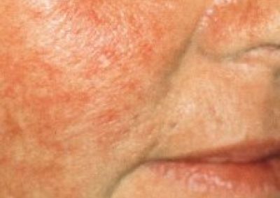 Rosacea Rosacea