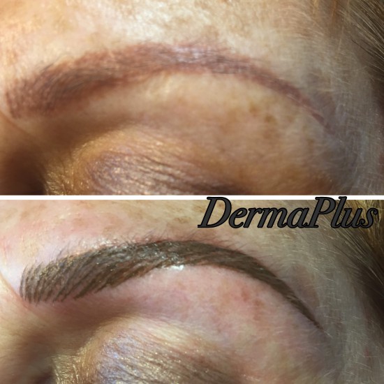 Herstel PMU 4 dermaplus Herstel PMU 4 dermaplus