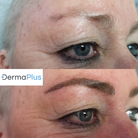 Hairstrokes Dermaplus Hairstrokes Dermaplus