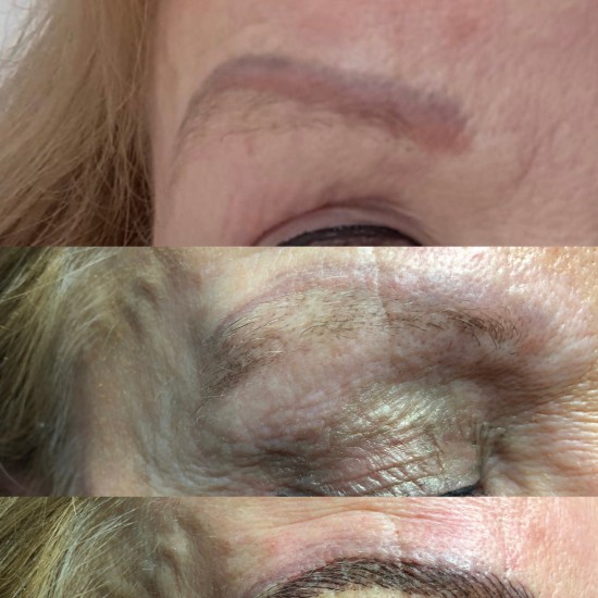 oude pmu verwijderd dermaplus oude pmu verwijderd dermaplus