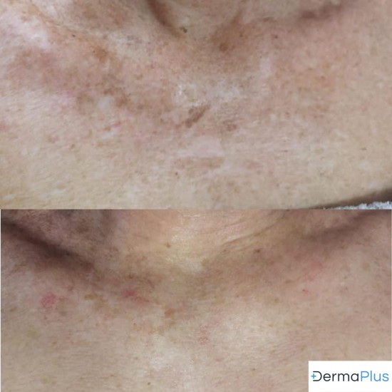 pigmentvlekken Dermaplus pigmentvlekken Dermaplus