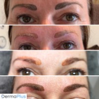 Herstel PMU 6 dermaplus Herstel PMU 6 dermaplus