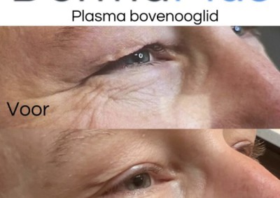 Plasmahuidlift Plasmahuidlift